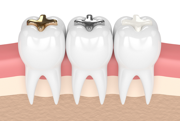 Dental Filling