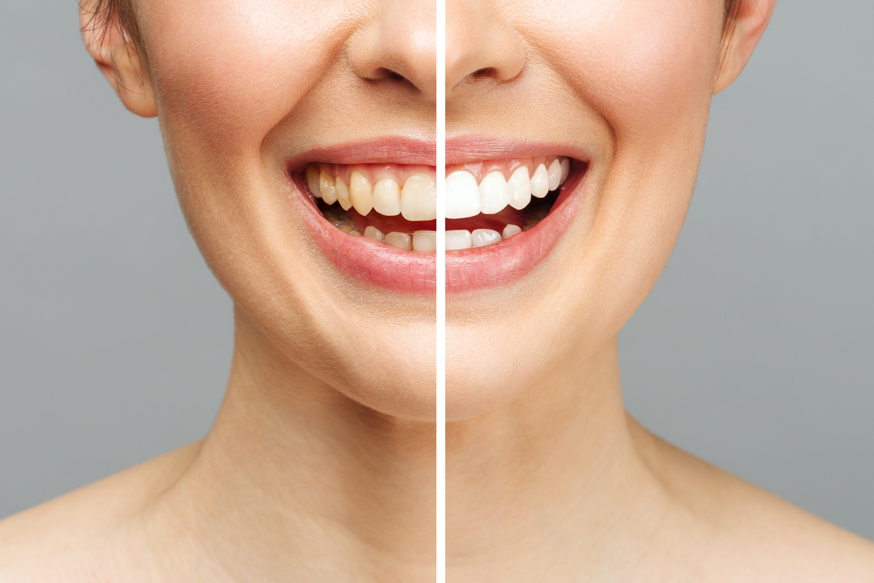 Dental Whitening
