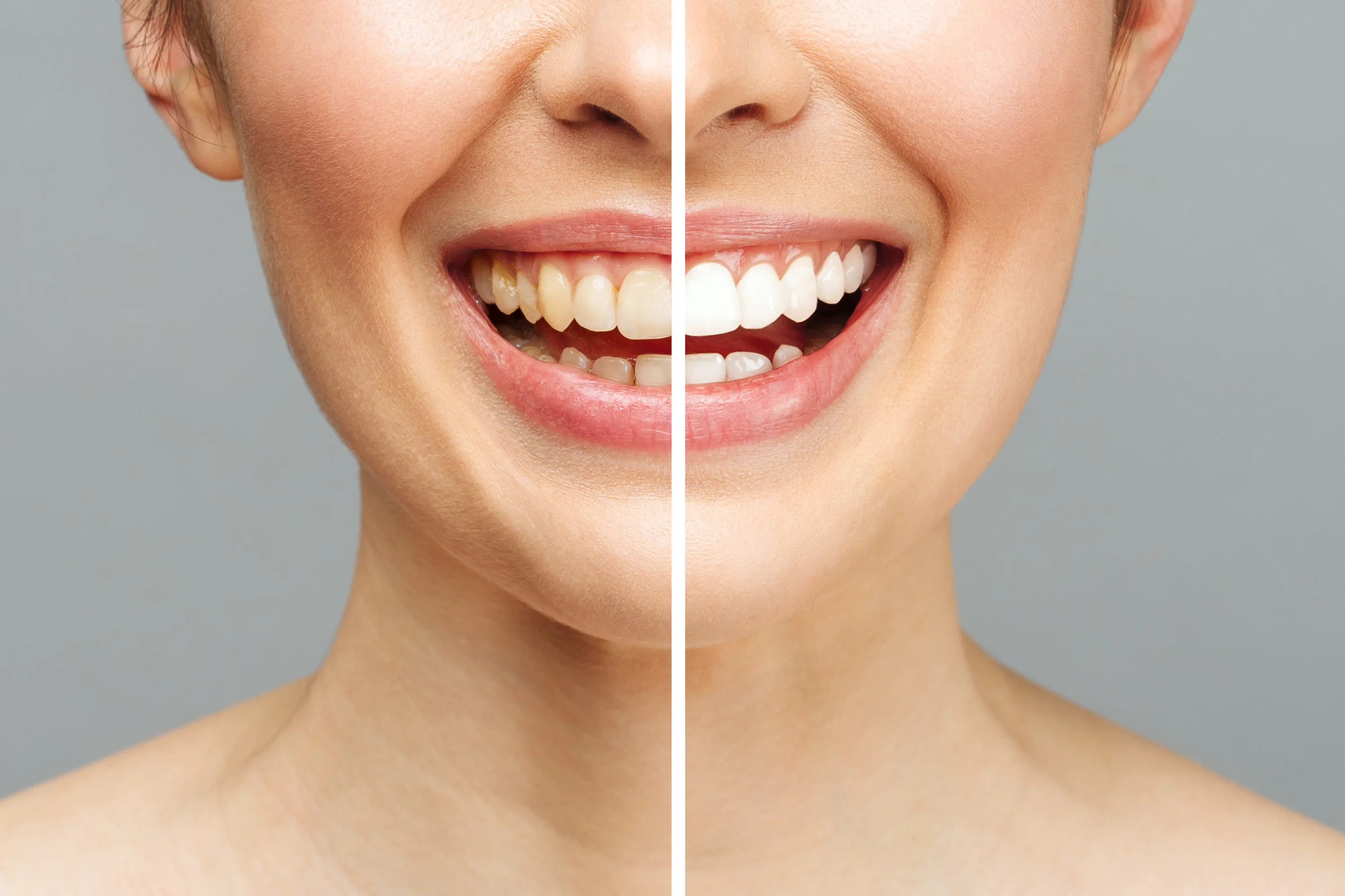 Dental Whitening