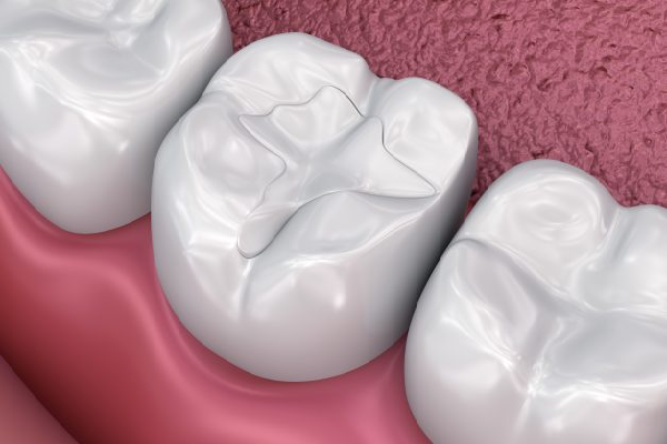 Dental Sealment