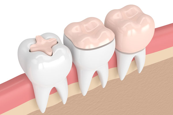 Dental Restoration