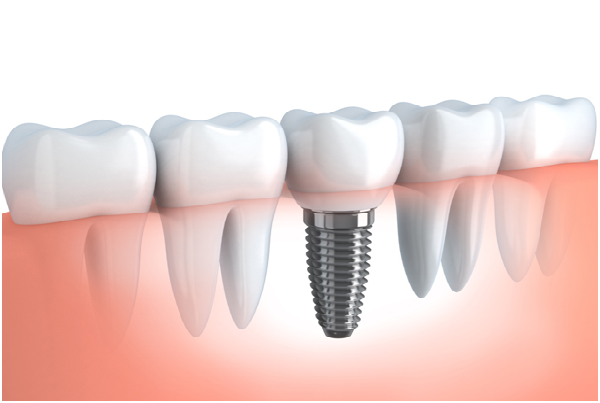 Tooth Replacement