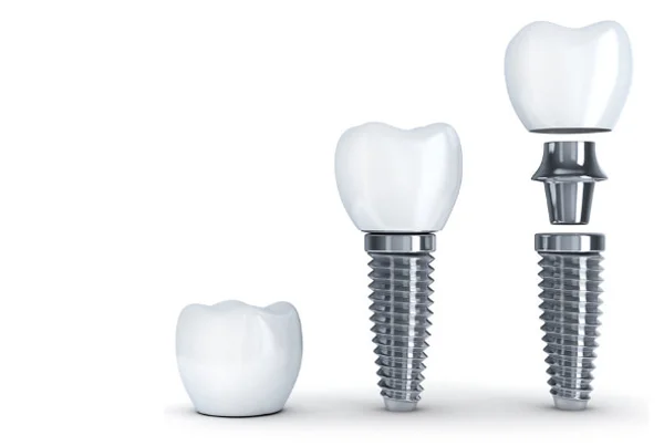 Dental Implants
