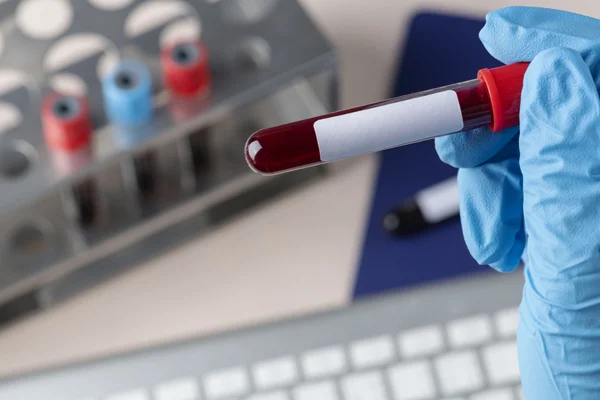 Uric Acid Test
